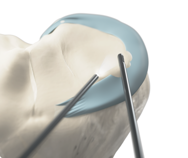 Arthroscopic removal
