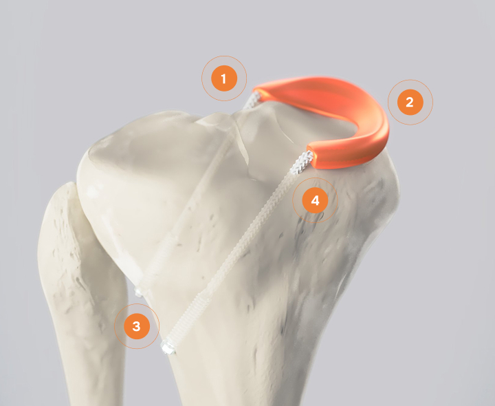 A diagram of the knee with the Orthonika TMR product. It shows 4 numbers 1 to the top left of the product, 2 to the top of the product, 3 to the bottom of the product, and 4 to the right of the product