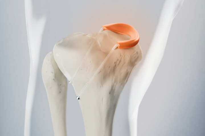 A visualisation of the knee bone with a transparent skin over the top featuring the Orthonika TMR